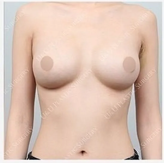 한쪽 가슴 재수술 후 사진 5