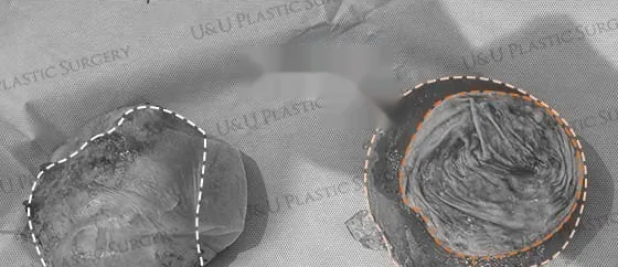 앙블락으로 제거한 피막과 파열된 보형물을 나란히 놓은 적출물 사진