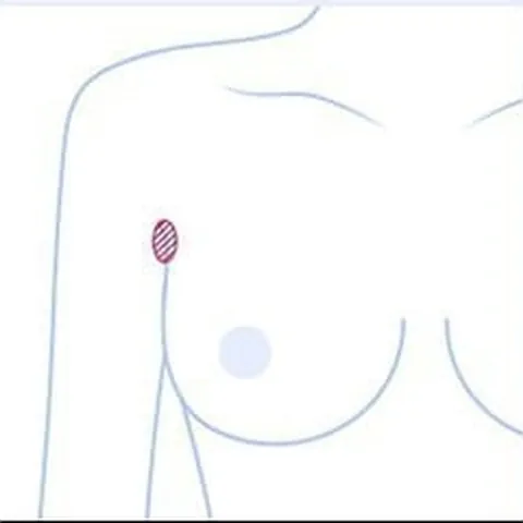 겨드랑이 절개 위치를 표시한 상반신 일러스트