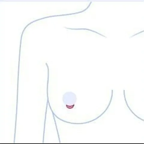 유륜 절개 위치를 표시한 상반신 일러스트