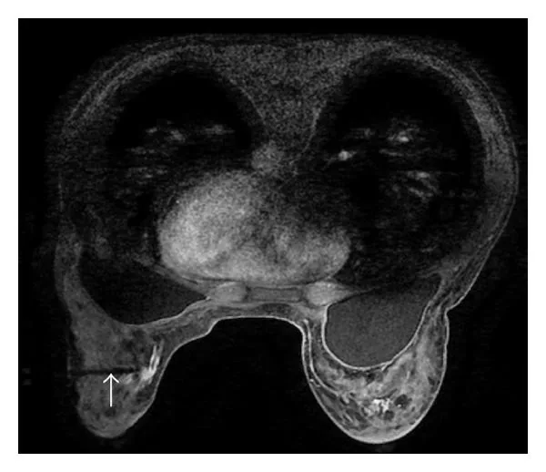 양쪽 가슴 보형물이 보이는 흉부 MRI 단면에 한쪽을 가리키는 화살표가 있다