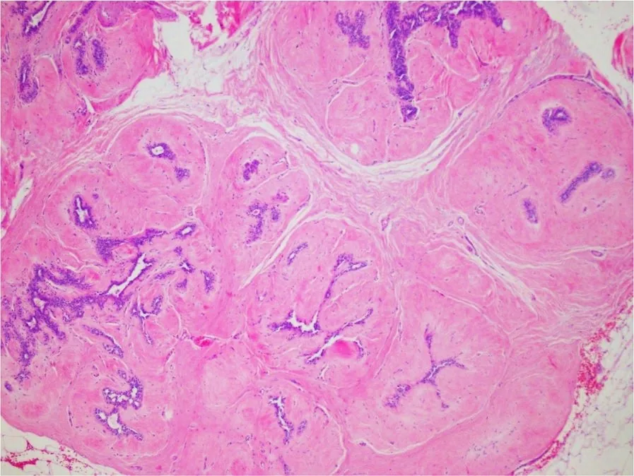 분홍빛 섬유 기질 사이에 보라색 유관 구조가 보이는 유방 조직 현미경 사진