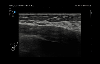 Healthy Breast 보형물 초음파 img10 m