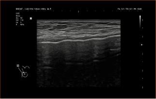 Healthy Breast 보형물 초음파 img11 m