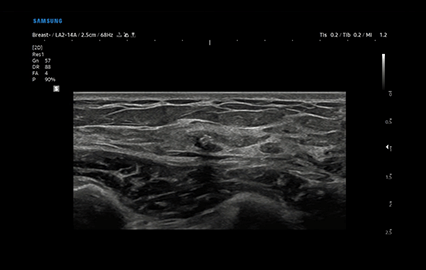 Healthy Breast 보형물 초음파 img5 m