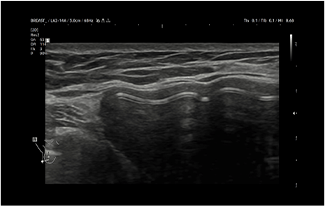 Healthy Breast 보형물 초음파 img6 m