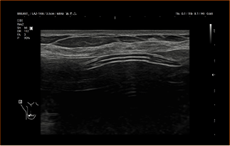Healthy Breast 보형물 초음파 img7 m