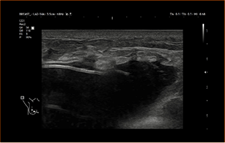 Healthy Breast 보형물 초음파 img8 m