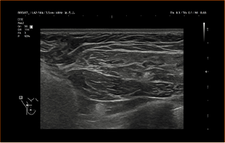 Healthy Breast 보형물 초음파 img9 m