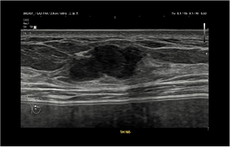 Healthy Breast 유방암 초음파 img10 m
