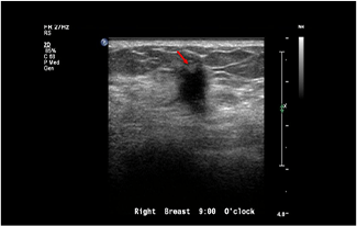 Healthy Breast 유방암 초음파 img11 m