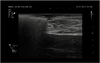 Healthy Breast 유방암 초음파 img14 m