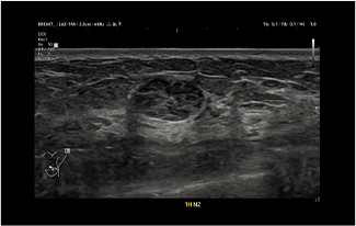 Healthy Breast 유방암 초음파 img9 m