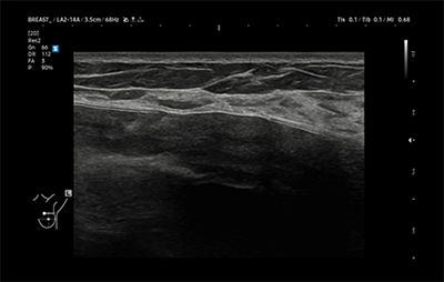 healthy breast 보형물초음파 img10