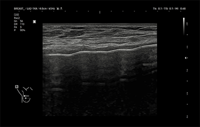 healthy breast 보형물초음파 img11
