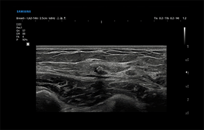 healthy breast 보형물초음파 img5