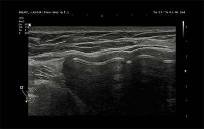 healthy breast 보형물초음파 img6