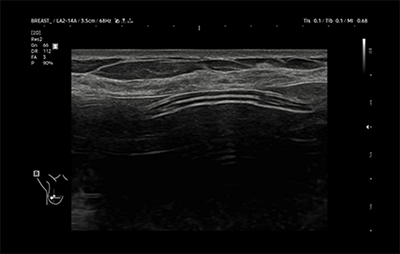 healthy breast 보형물초음파 img7