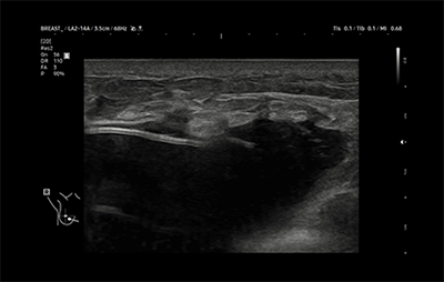 healthy breast 보형물초음파 img8