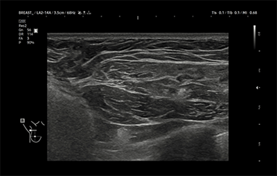 healthy breast 보형물초음파 img9