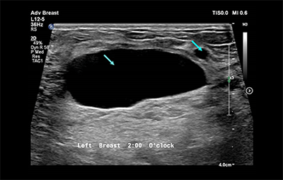 healthy breast 유방암초음파 img10