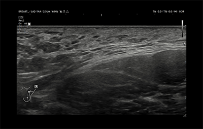 healthy breast 유방암초음파 img11