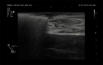 healthy breast 유방암초음파 img12