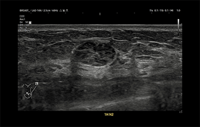 healthy breast 유방암초음파 img7