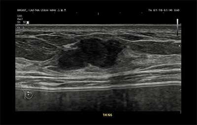 healthy breast 유방암초음파 img8