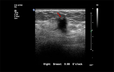 healthy breast 유방암초음파 img9