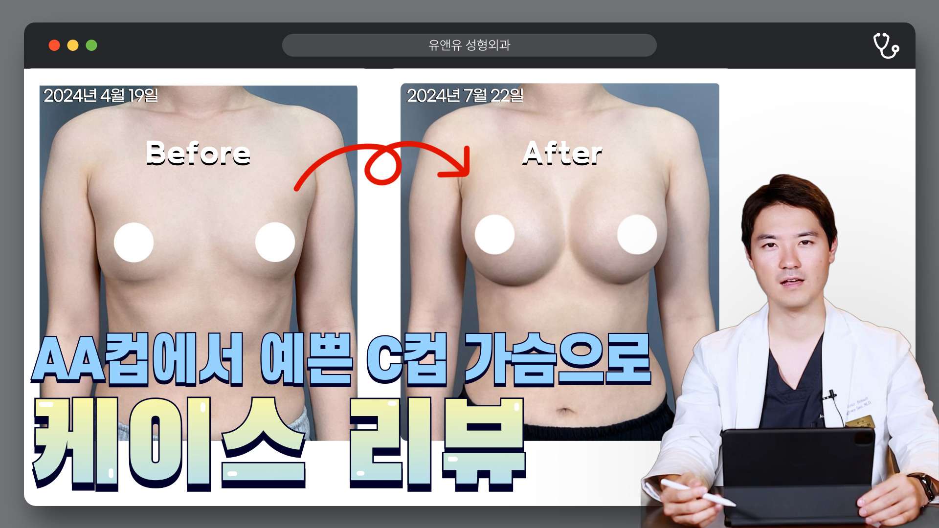 가슴성형 케이스 리뷰 영상