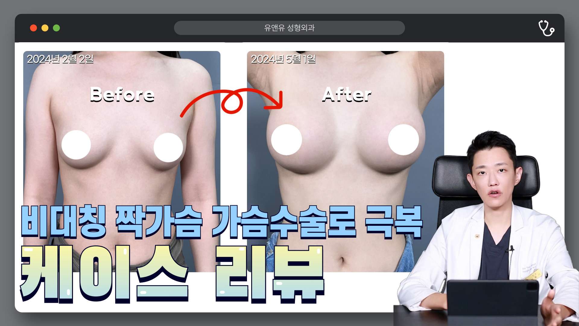 비대칭 짝가슴 극복 가슴수술 사례 영상