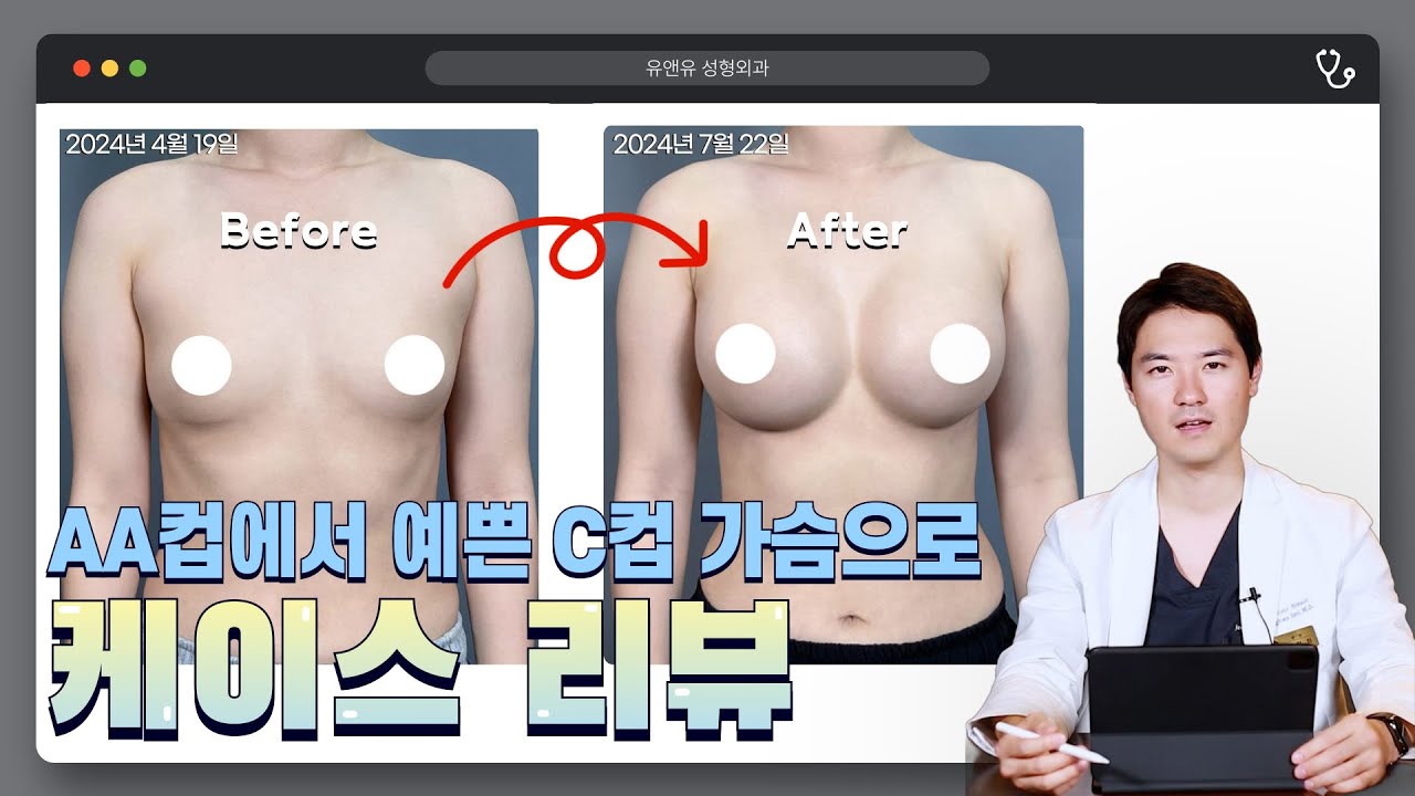 [가슴성형 케이스리뷰] 75aa컵→C컵 가슴수술 I 절벽가슴에서 예쁜가슴으로 다시 태어나다👋