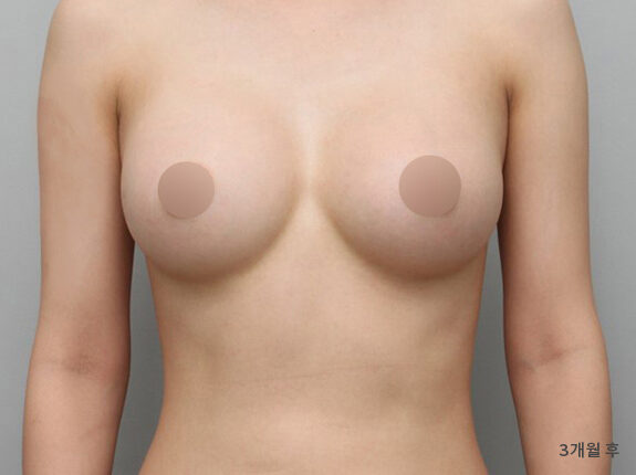 乳房偏小 術前