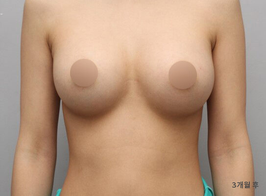 乳房偏小 術前