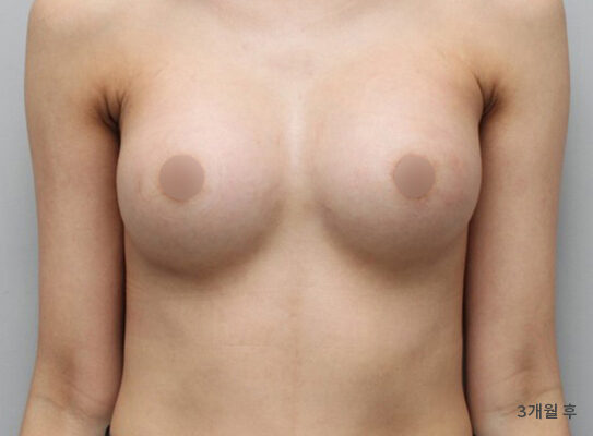 乳房偏小 術前