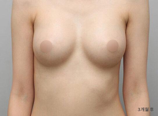 乳房偏小 術前