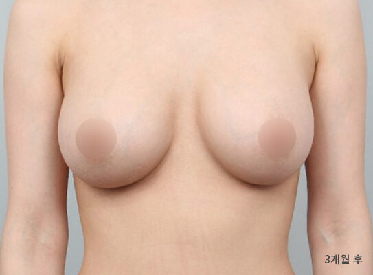 乳房偏小 術前