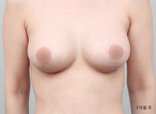 乳房偏小 術前