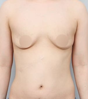 복부·가슴 동시 거상 수술 전