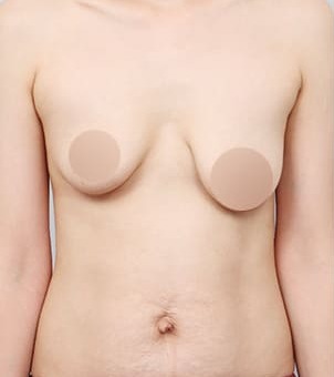 복부·가슴 동시 거상 수술 전