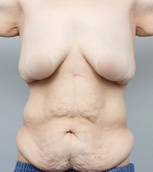 복부·가슴 동시 거상 수술 전